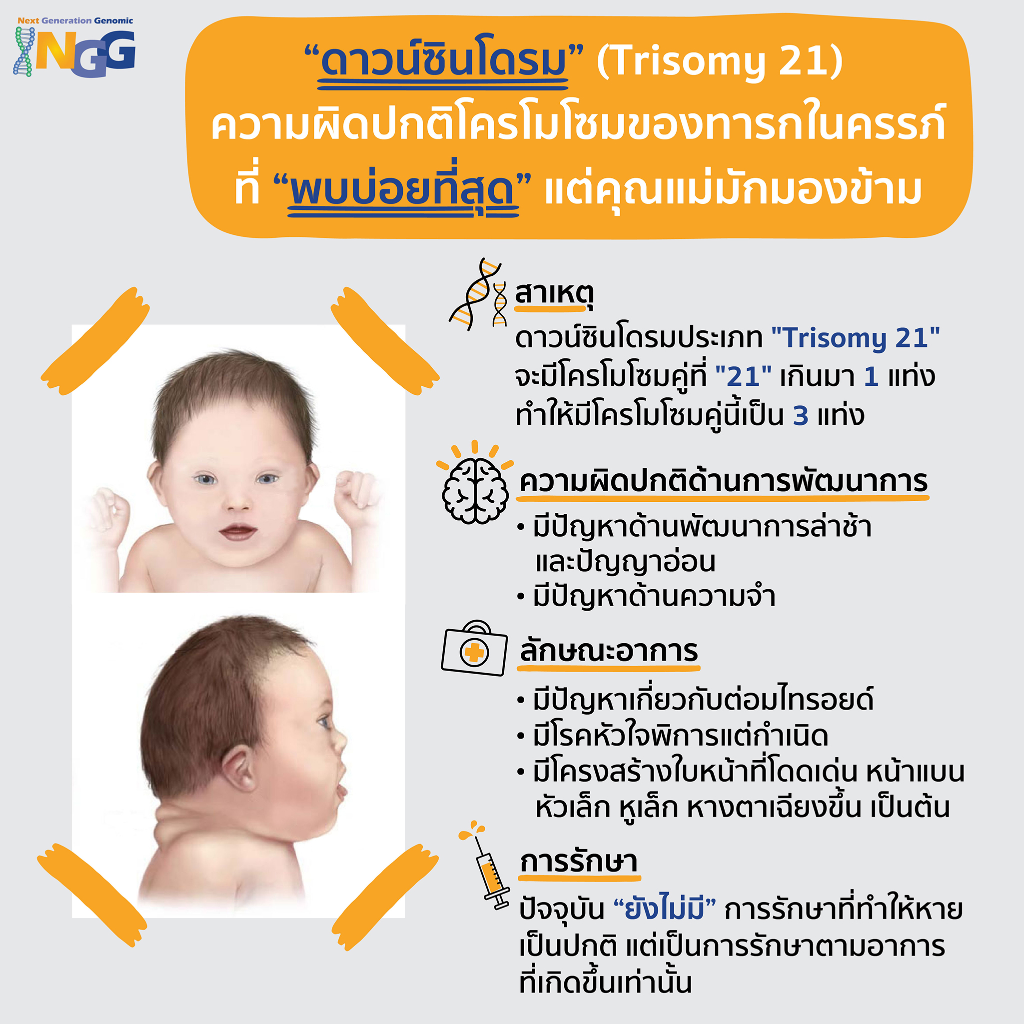 ดาวน์ซินโดรม Trisomy 21 ความผิดปกติโครโมโซมของทารกในครรภ์ที่พบบ่อย