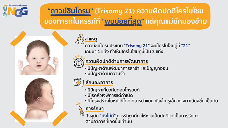 ดาวน์ซินโดรม (Trisomy 21) ความผิดปกติโครโมโซมของทารกในครรภ์ที่พบบ่อยที่สุด แต่คุณแม่มักมองข้าม