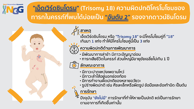 เอ็ดเวิร์ดซินโดรม (Trisomy 18) ความผิดปกติโครโมโซมของทารกในครรภ์ที่พบได้บ่อยเป็นอันดับ 2 รองจากดาวน์ซินโดรม