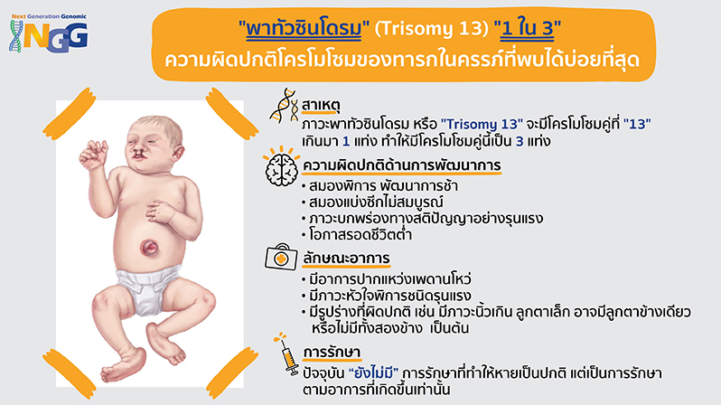 พาทัวซินโดรม (Trisomy 13) 1 ใน 3 ความผิดปกติโครโมโซมของทารกในครรภ์ที่พบได้บ่อยที่สุด