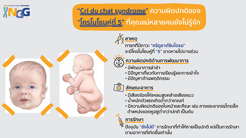 Cri du chat syndrome ความผิดปกติของโครโมโซมคู่ที่ 5 ที่คุณแม่หลายคนยังไม่รู้จัก