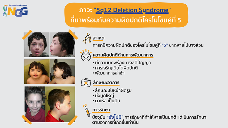 ภาวะ 5q12 deletion syndrome ที่มาพร้อมกับความผิดปกติโครโมโซมคู่ที่ 5