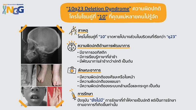 10q23 deletion syndrome ความผิดปกติโครโมโซมคู่ที่ 10 ที่คุณแม่หลายคนไม่รู้จัก