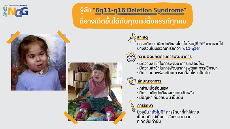 รู้จัก 6q11-q16 deletion syndrome ที่อาจเกิดขึ้นได้กับคุณแม่ตั้งครรภ์ทุกคน