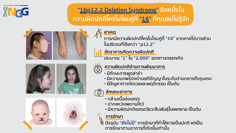 16p12.2 deletion syndrome อีกหนึ่งในความผิดปกติโครโมโซมคู่ที่ 16 ที่คุณแม่ไม่รู้จัก