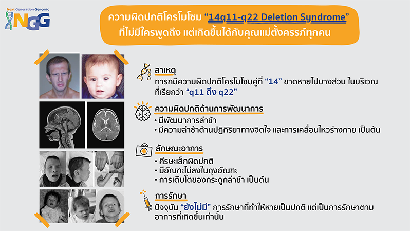 16p12.2 deletion syndrome อีกหนึ่งในความผิดปกติโครโมโซมคู่ที่ 16 ที่คุณแม่ไม่รู้จัก